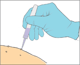 Apply YCANTH solution to lesion